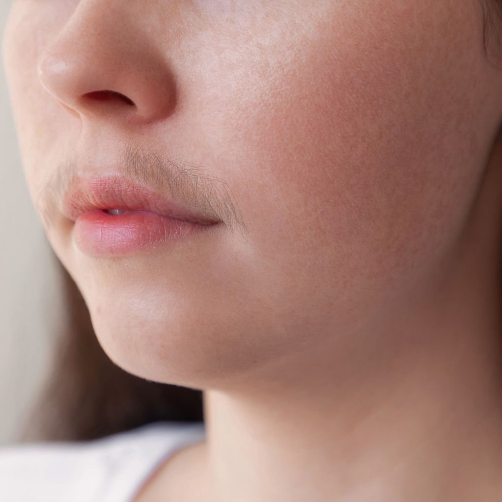 Hirsutism in Women: Causes, Treatments, Supplements, & Solutions