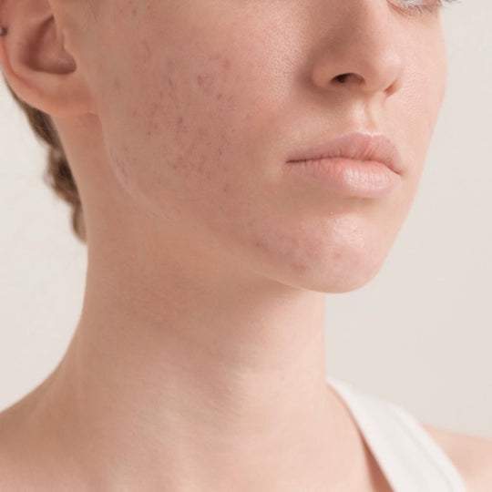 PCOS Symptom Facial Acne